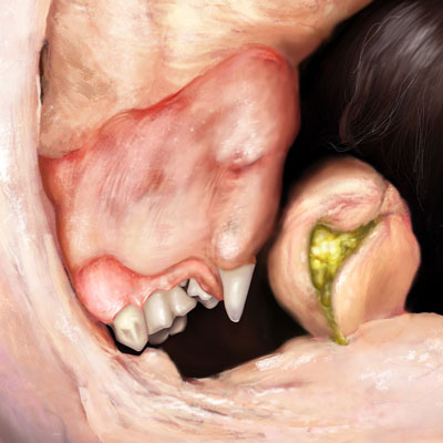 dermoid ovarian cyst illustration