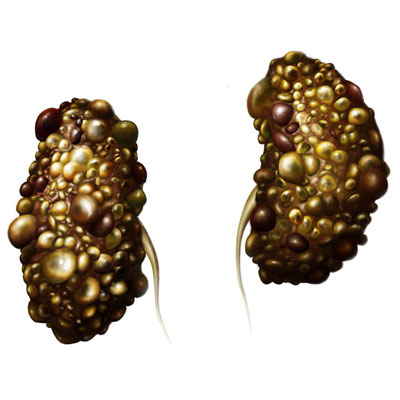 polycystic kidneys